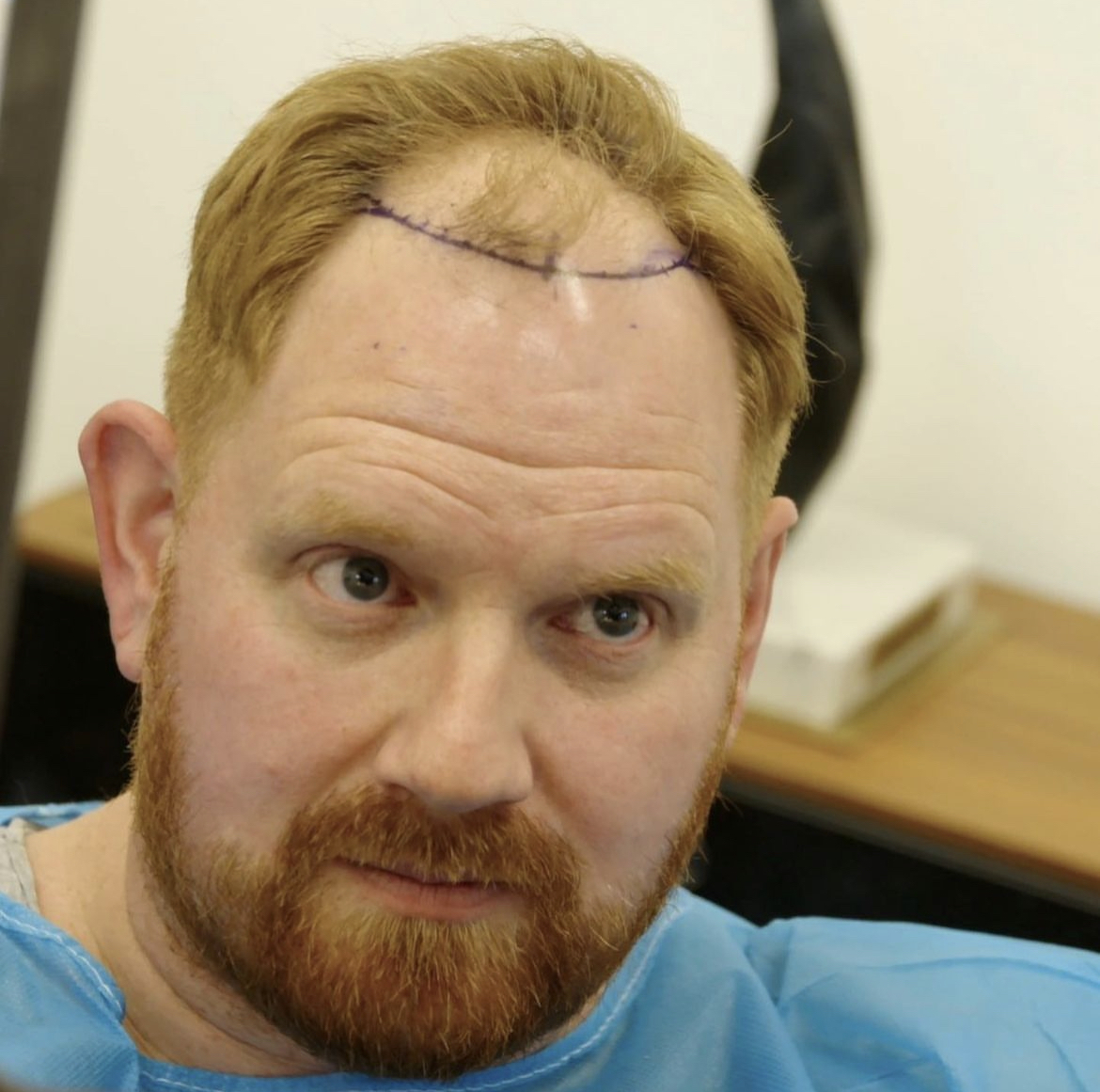 До и после проведения процедур по пересадке волос в клинике Vital Graft