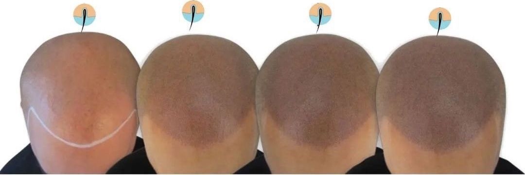 Этапы процедуры трихопигментации