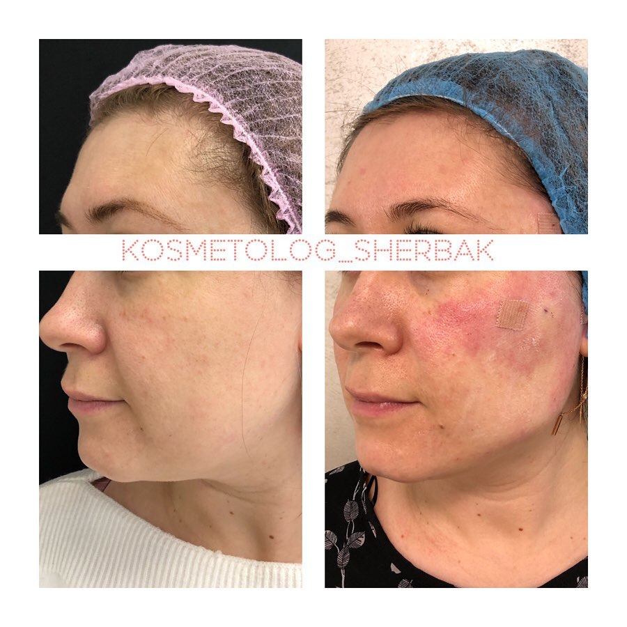 Фото до и после: нитевой лифтинг лица в клинике PradusCOSMO, Санкт-Петербург. Безоперационное омоложение с сохранением естественной мимики