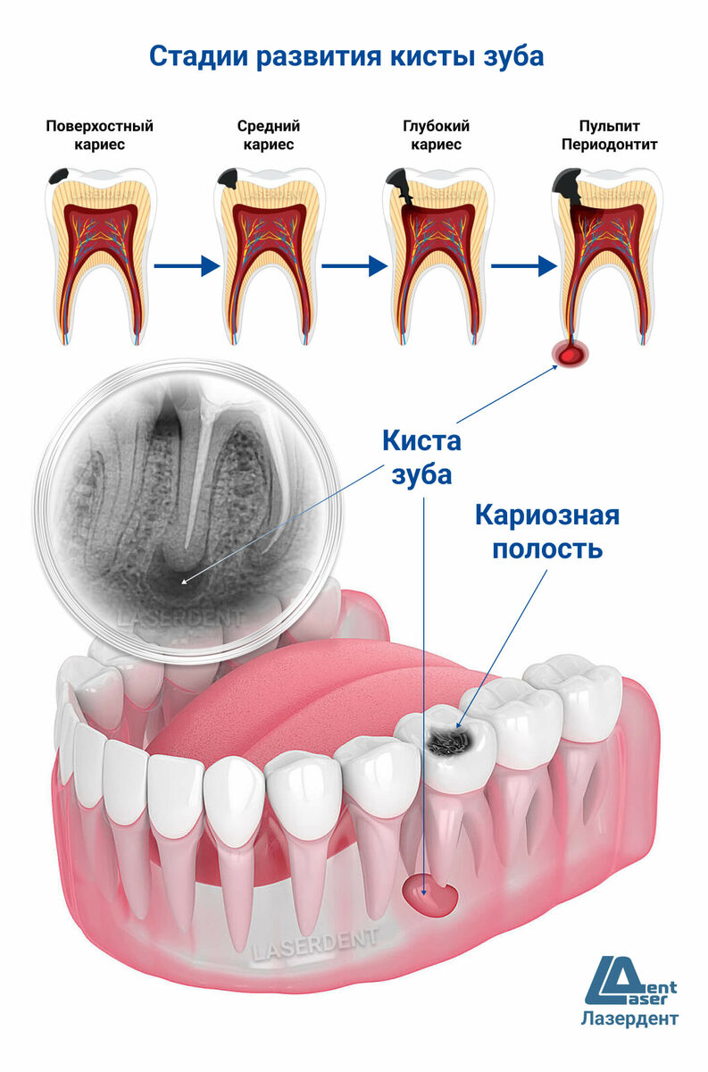 Удаление и Лечение Кисты Зуба в Хабаровске. Cтоматология Лазердент