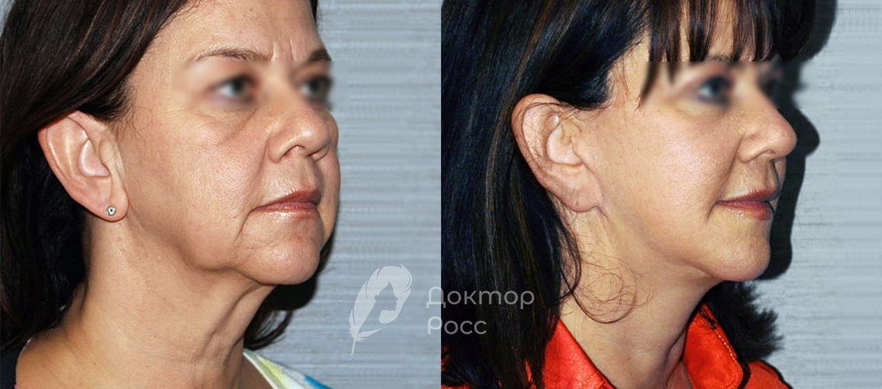 Подтяжка лица хирургическим путем до и после фото