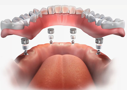 Покрывной протез на имплантах