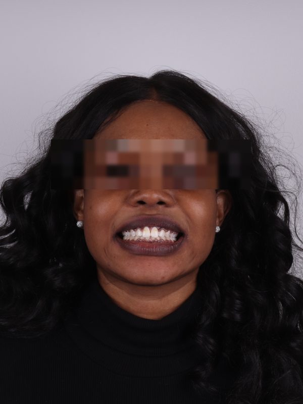 Исправление прикуса — фото после лечения, Elite Denta