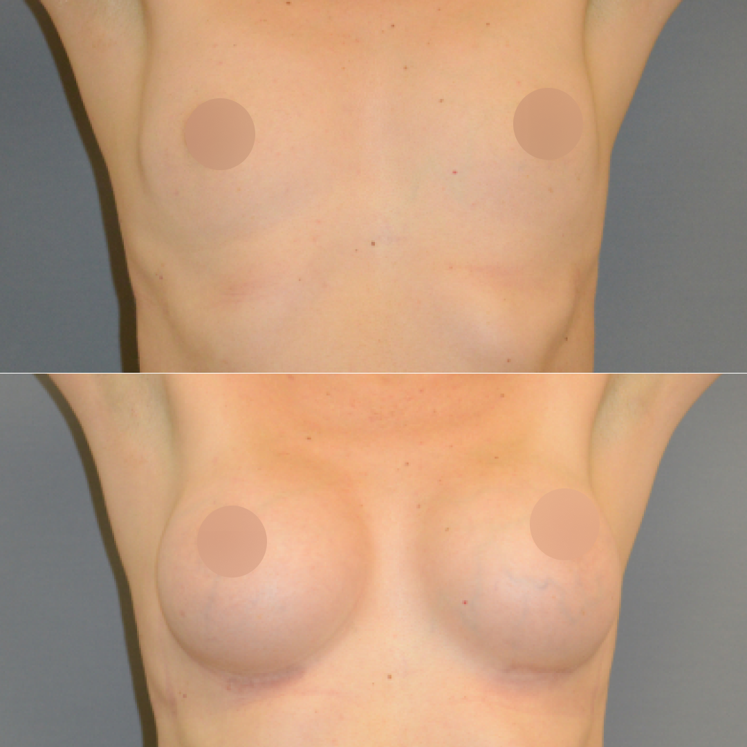 маммопластика одна грудь ниже другой фото 65