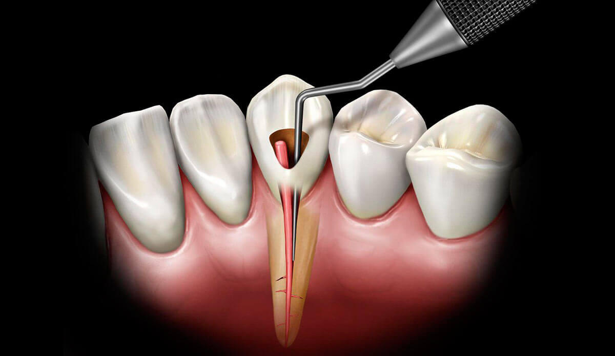 Депульпирование зуба