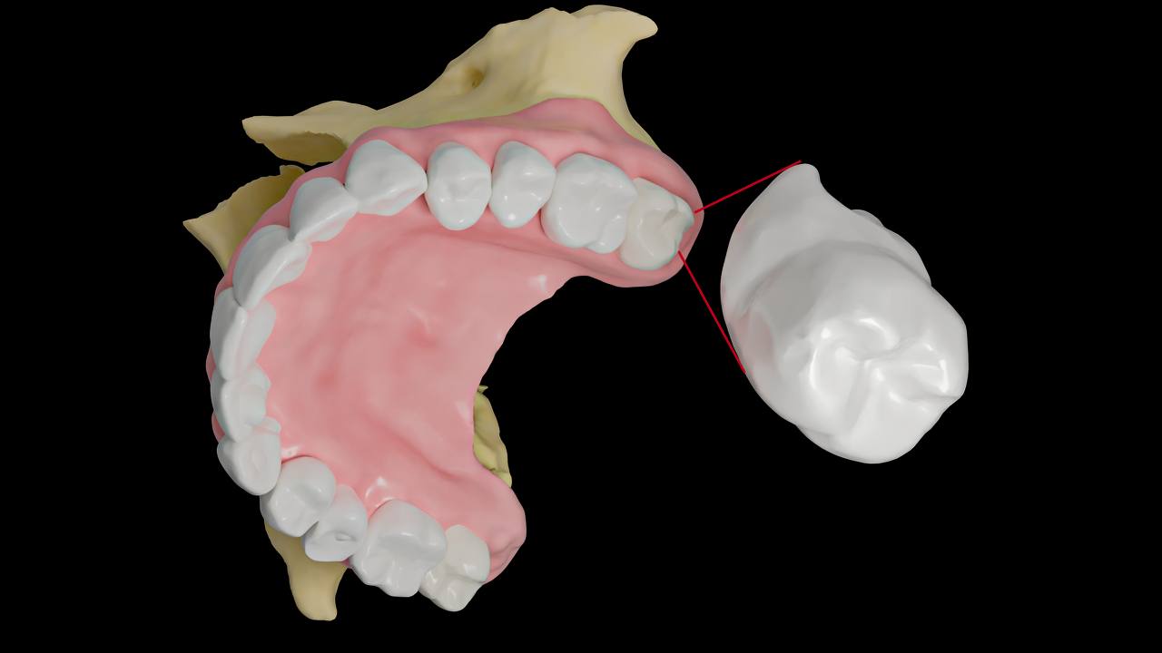 сложное удаление зуба мудрости в верхней челюсти