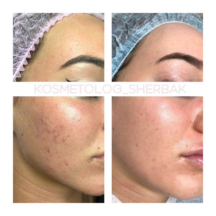 Индивидуальный подбор домашнего ухода в клинике PradusCOSMO, Санкт-Петербург. Косметологический анализ кожи и рекомендация профессиональной косметики