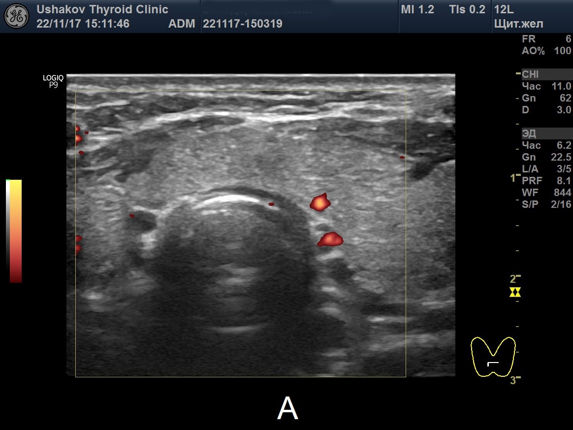 Видеолекции узи изранов. УЗИ щитовидной железы Изранов. УЗИ Изранов видеолекции. УЗИ предстательной железы Изранов.