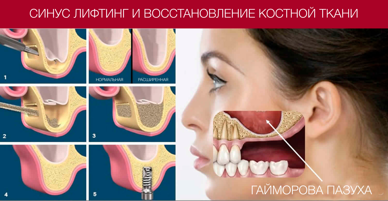 Восстановление костной ткани зубов. Синус-лифтинг (в зависимости от метода). Синус-лифтинг (костная пластика, остеопластика). Остеотомный синус лифтинг.