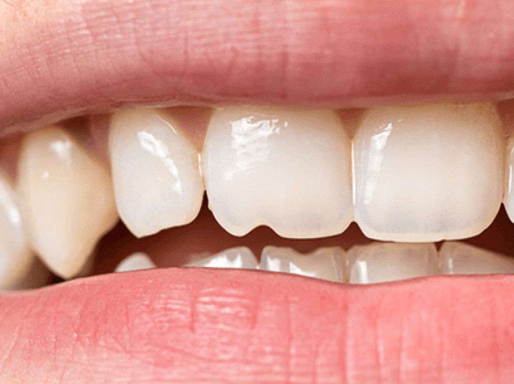 Скол зуба - что делать, если у вас откололся кусок зуба?