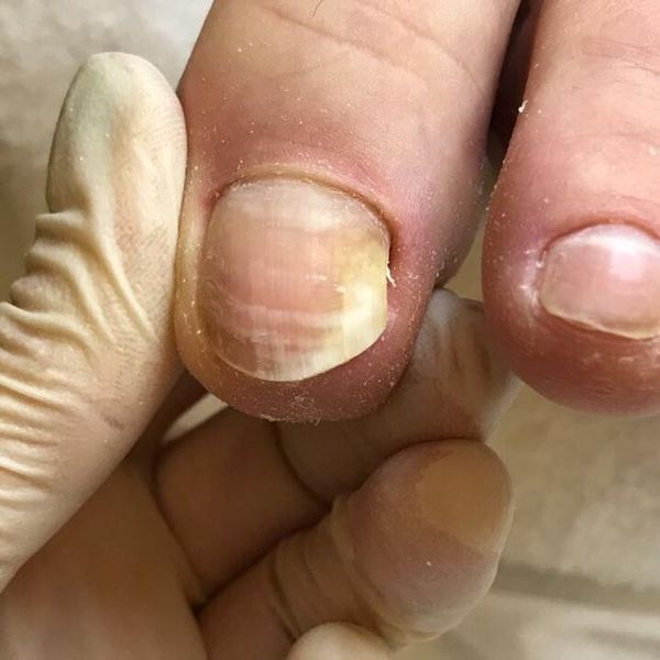 Как лечить нарыв под ногтем