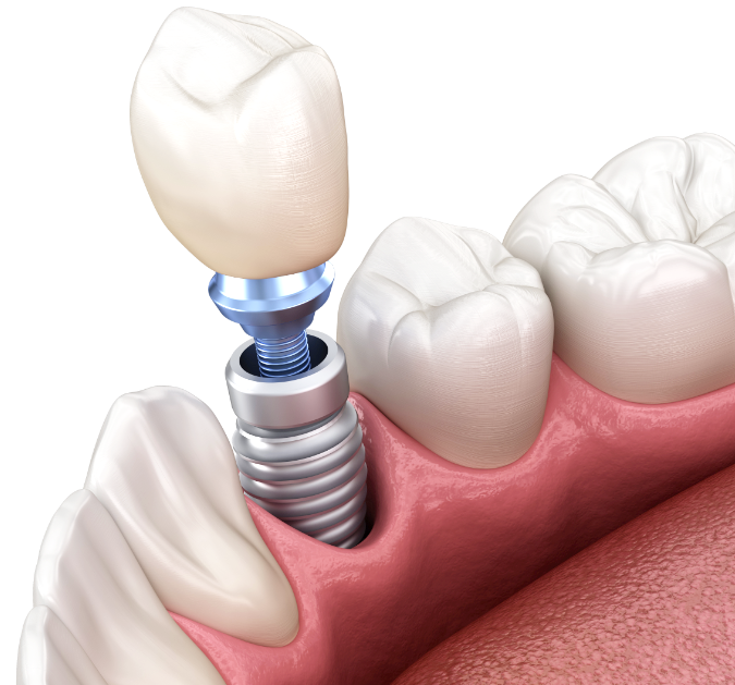 Как устанавливают имплант зуба!? - Юни