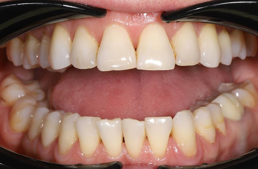 Выравнивание нижних зубов элайнерами