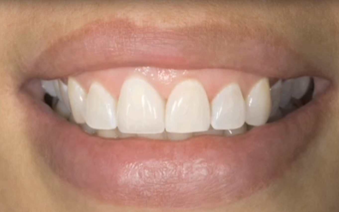 Красивые зубы из диоксида циркония