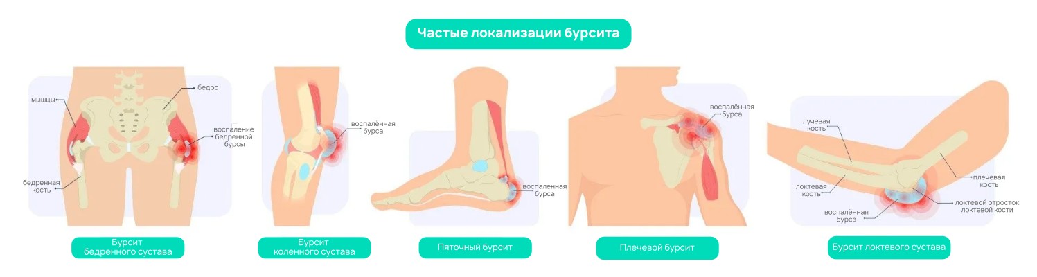 Как лечить бурсит в домашних условиях