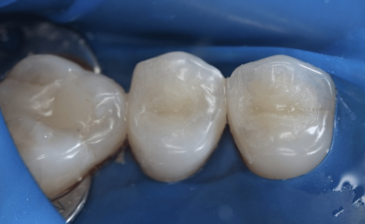 Лечение кариеса зуба на Мичуринском - цена