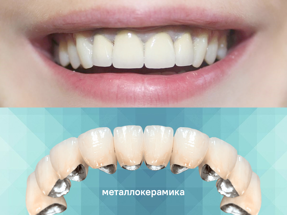 Реставрация зубов — коронки, виниры в Пушкино и Королеве — стоматология  Future Smile