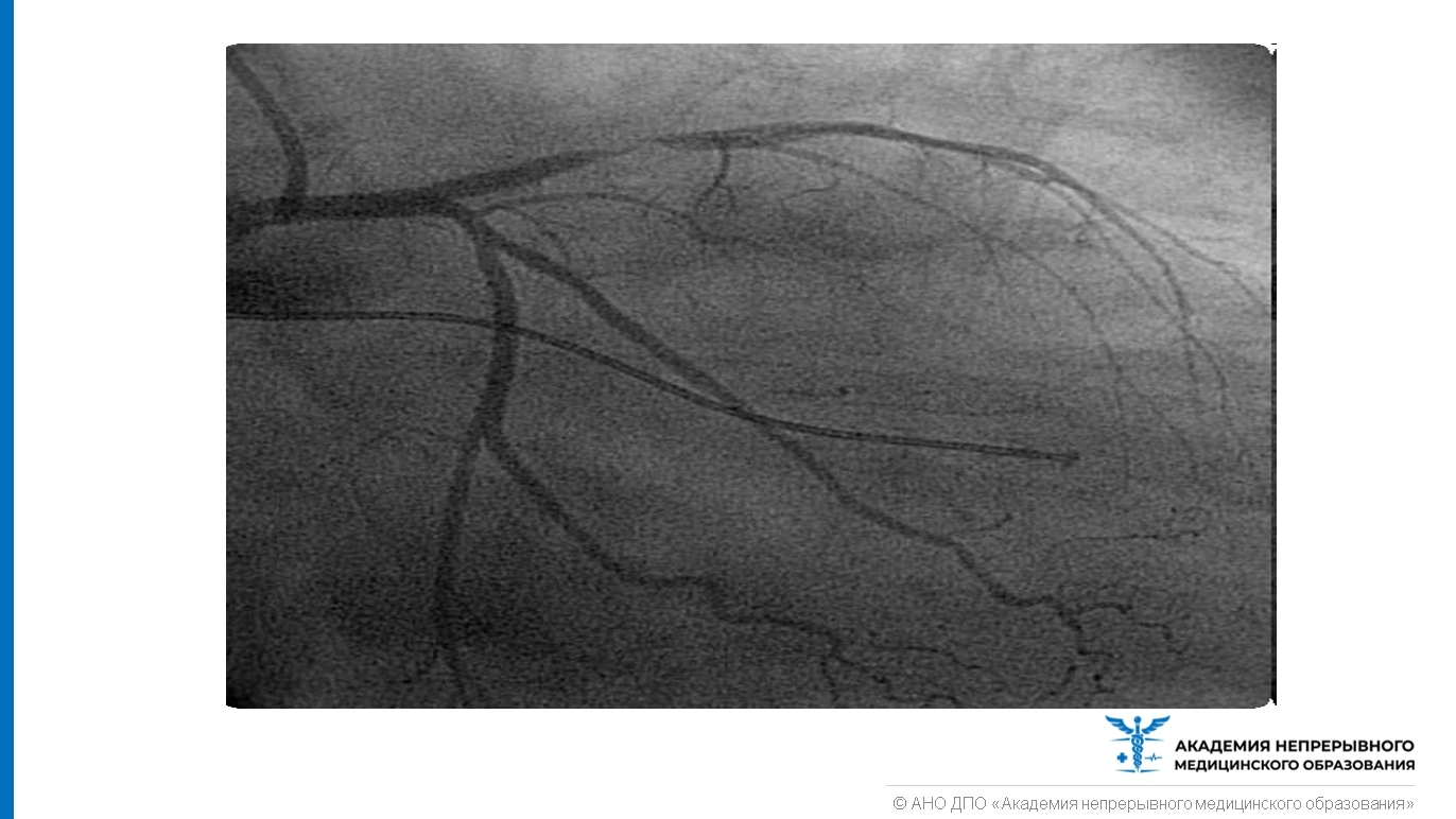Коронарография сосудов сердца что это