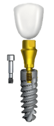 титановый абатмент, имплантация зубов в Санкт-Петербурге узнать точную стоимость протезирования