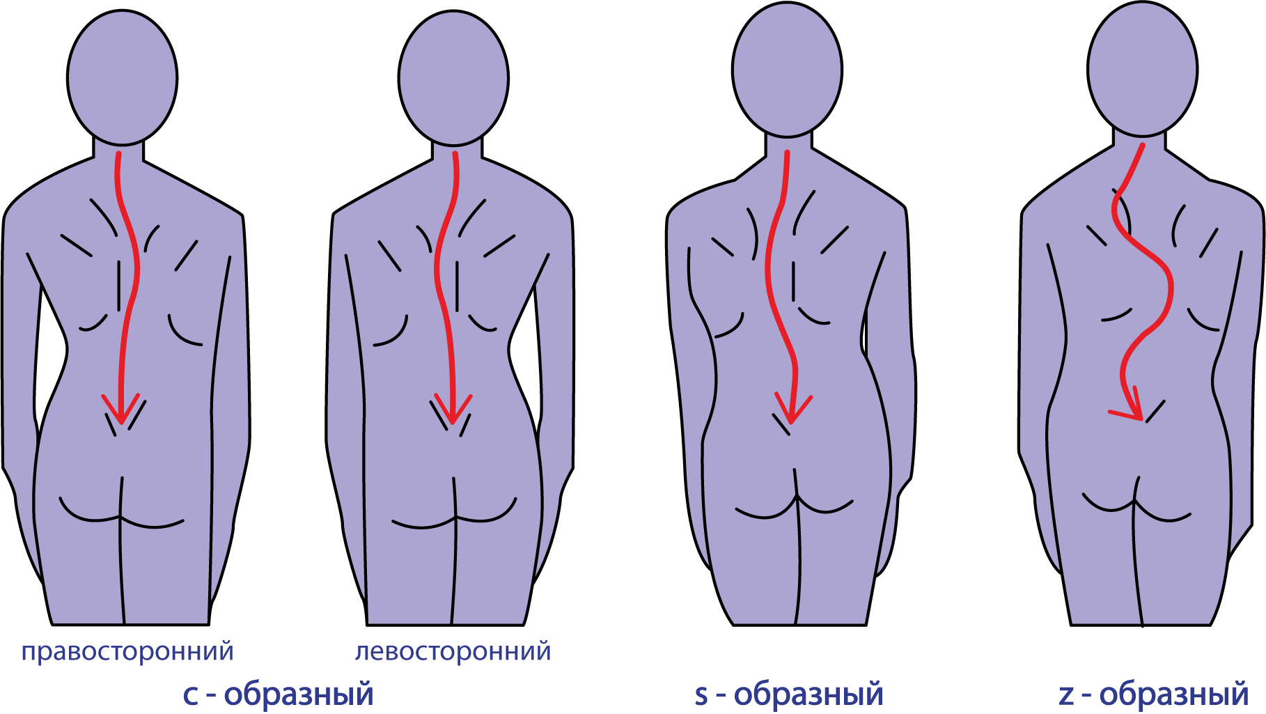 Последствия сколиоза