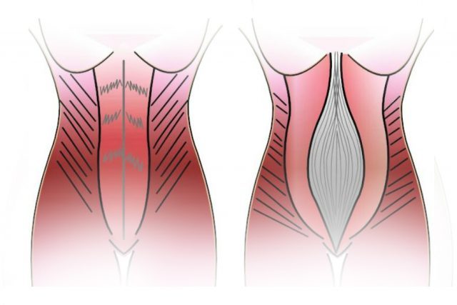 Диастаз прямых мышц живота: симптомы, лечение в Юсуповской больнице в ...