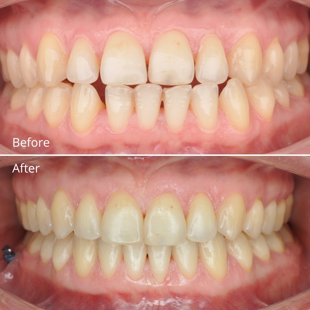 Stage photo showing mini-implant-anchored distalization of the lower arch — photo 2 of 5