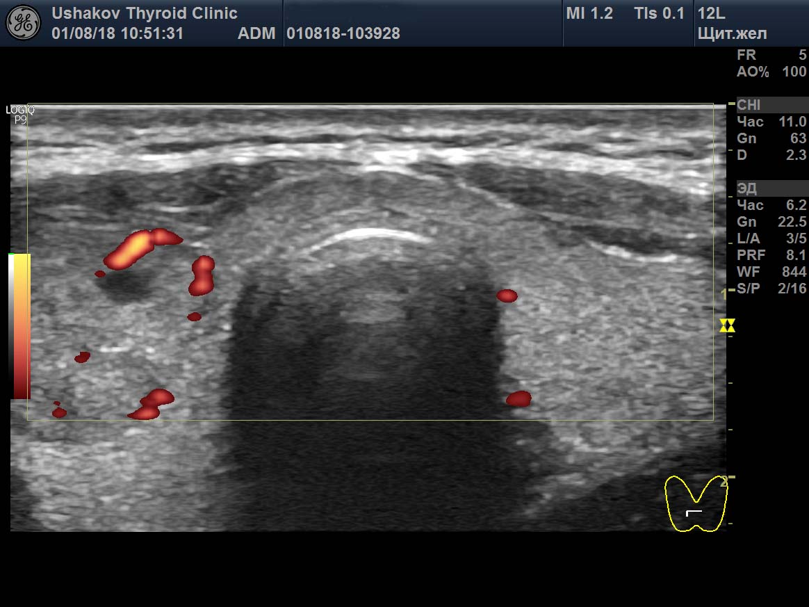 Узи щитовидной подготовка