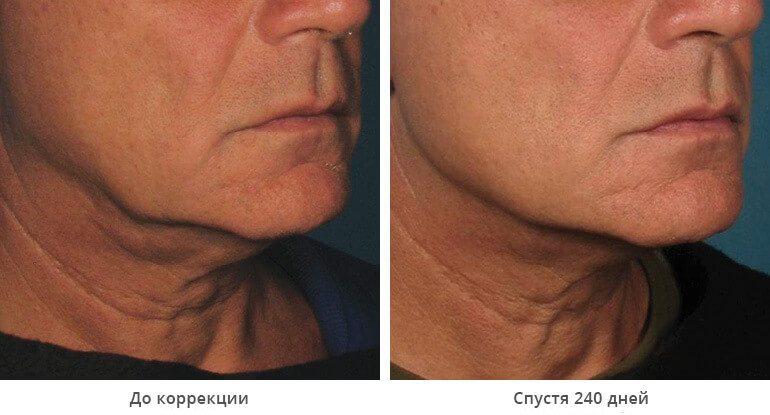 SMAS лифтинг Ulthera в Москве, цены на Альтера терапию, фото