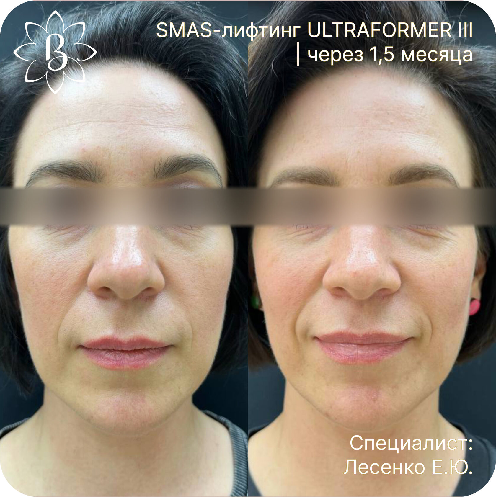 Александритовая лазерная эпиляция СПб