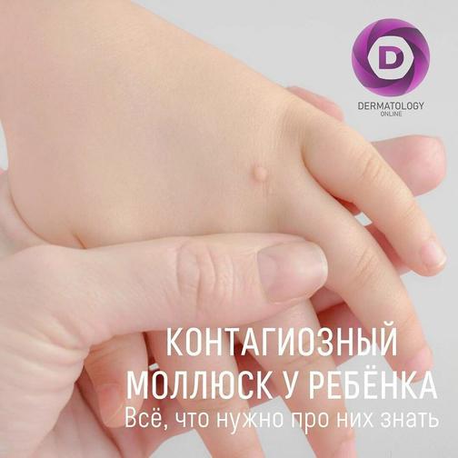 Контагиозный моллюск у ребёнка, причины, лечение