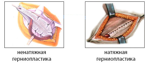 Натяжная и ненатяжная герниопластика