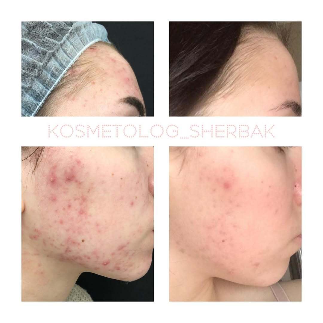 Лечение акне у женщины в клинике PradusCOSMO, СПб. До и после процедуры