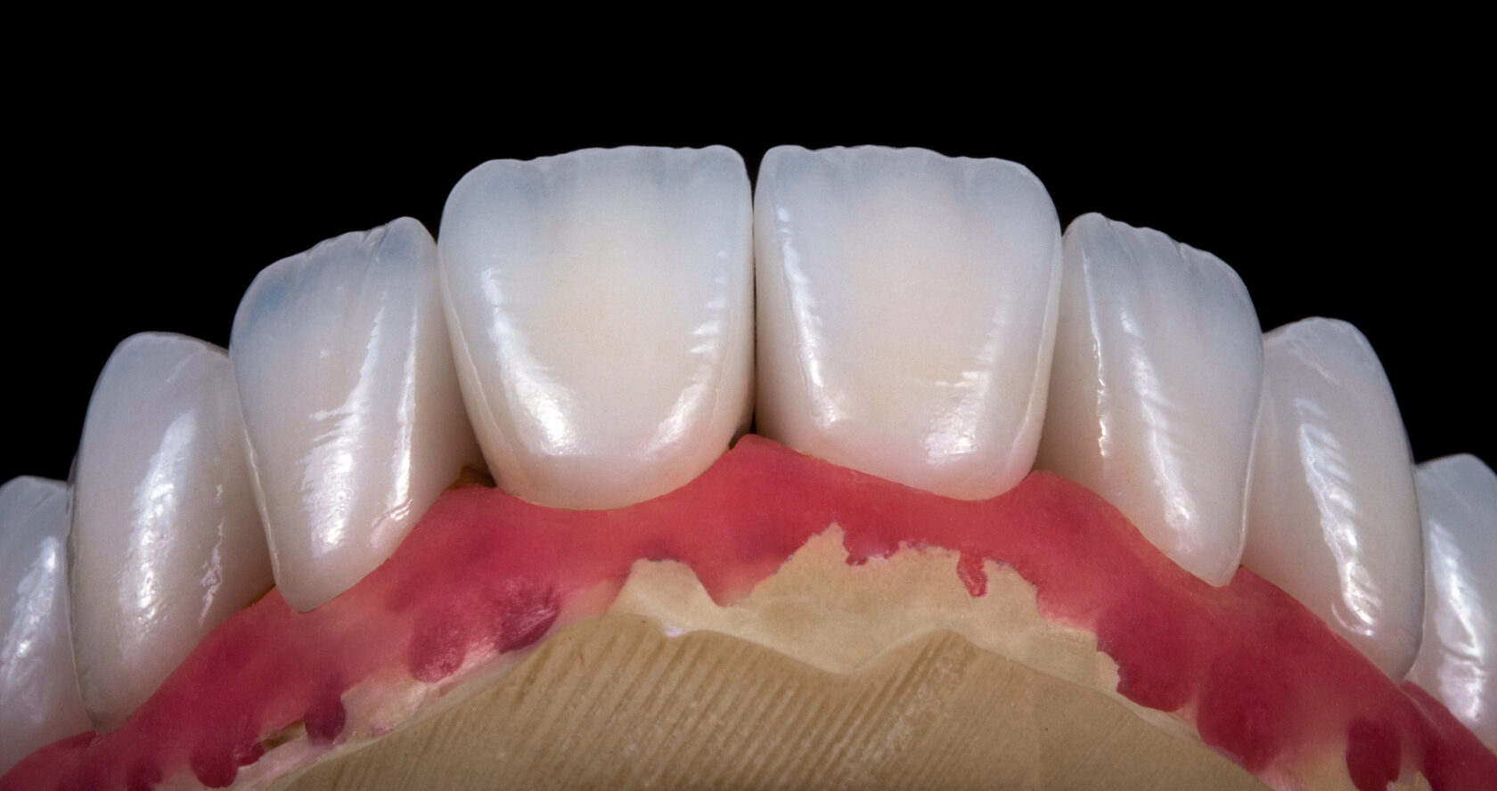 фото зубов циркониевые