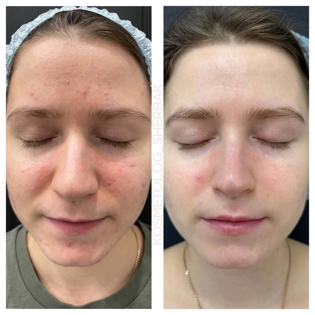 Лечение акне у женщины в клинике PradusCOSMO, СПб. До и после процедуры