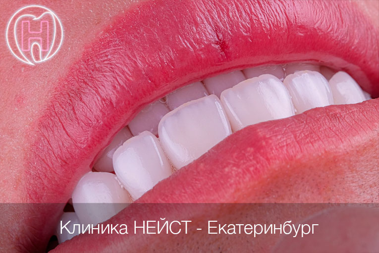 мужские керамические виниры Премиум Екатеринбург цвет Блич 3 (Bleach 3)