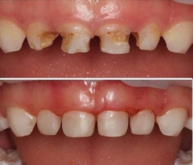 Когда молочные зубы меняются на коренные?