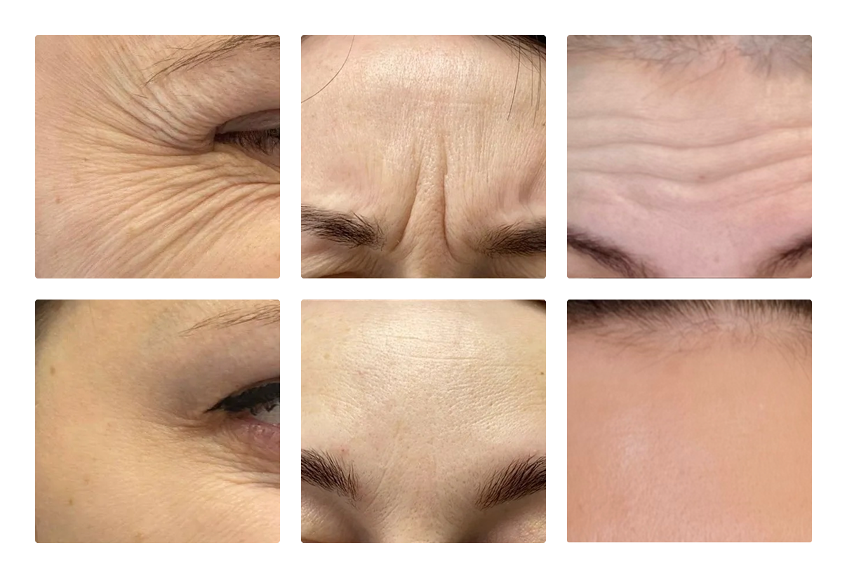 ботокс в лоб, межбровье, вокруг глаз: до и после