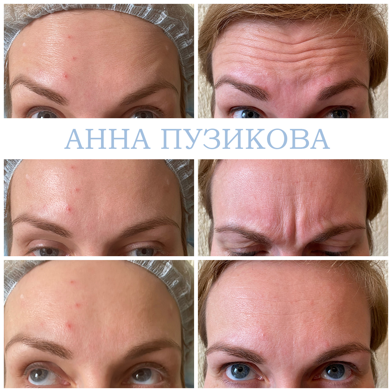 Результат ботулинотерапии — коррекция мимических морщин на лбу и в области глаз. Косметолог Пузикова Анна Анатольевна, Санкт-Петербург