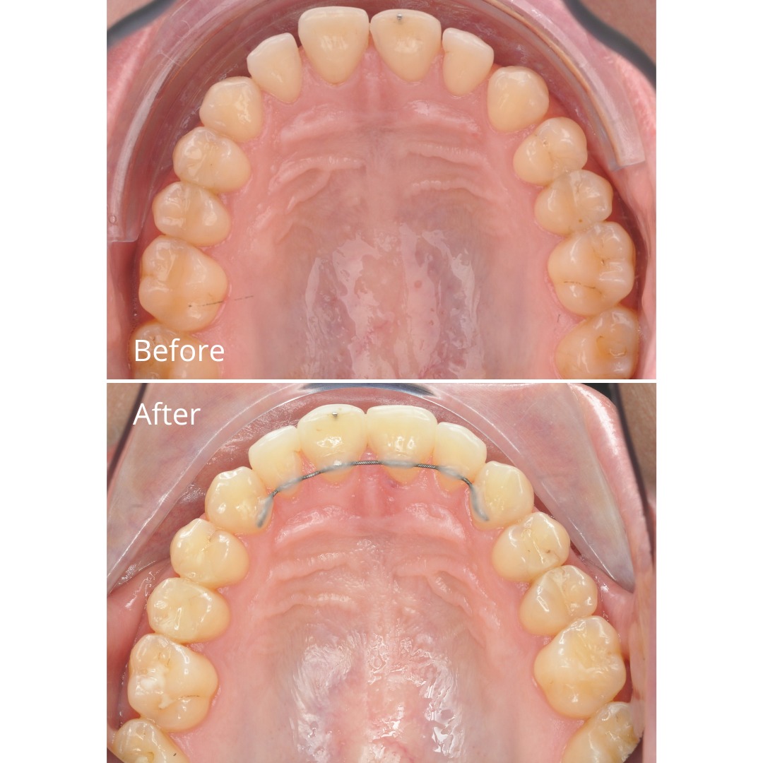 Stage photo documenting diastema closure during ongoing treatment — photo 3 of 5