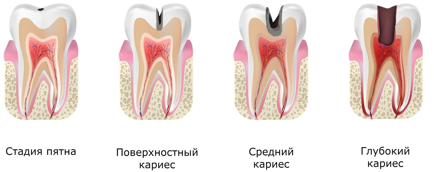 Лечение кариеса в клинике Доктора Раада