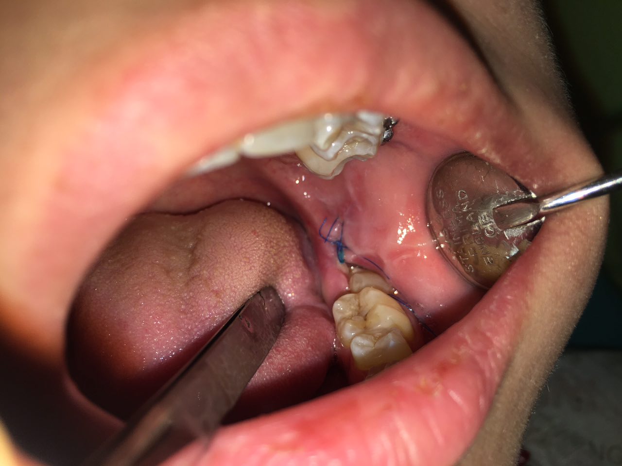 Почему зуб мудрости растет криво