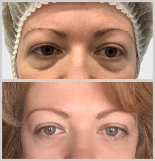 блефаропластика нависшие веки