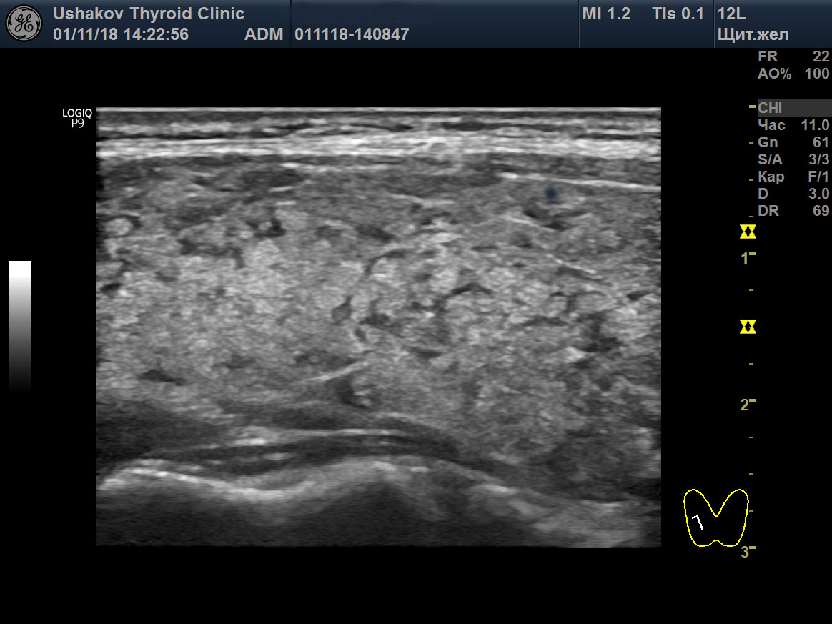 Изоэхогенный узел щитовидной железы. Регенерация щитовидной железы. Спайки в щитовидной железе. Восстановление щитовидной железы Ушаков. Ушаков а.в.восстановление щитовидной.