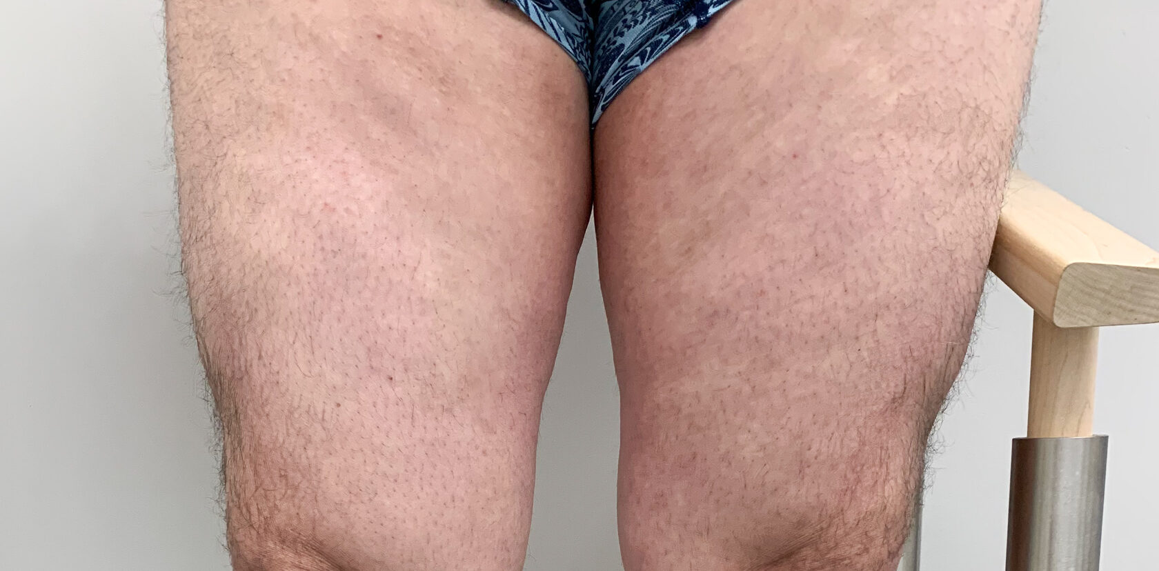 Identifying and Treating Shingles on Your Leg and Groin - Pensler Vein  Institute