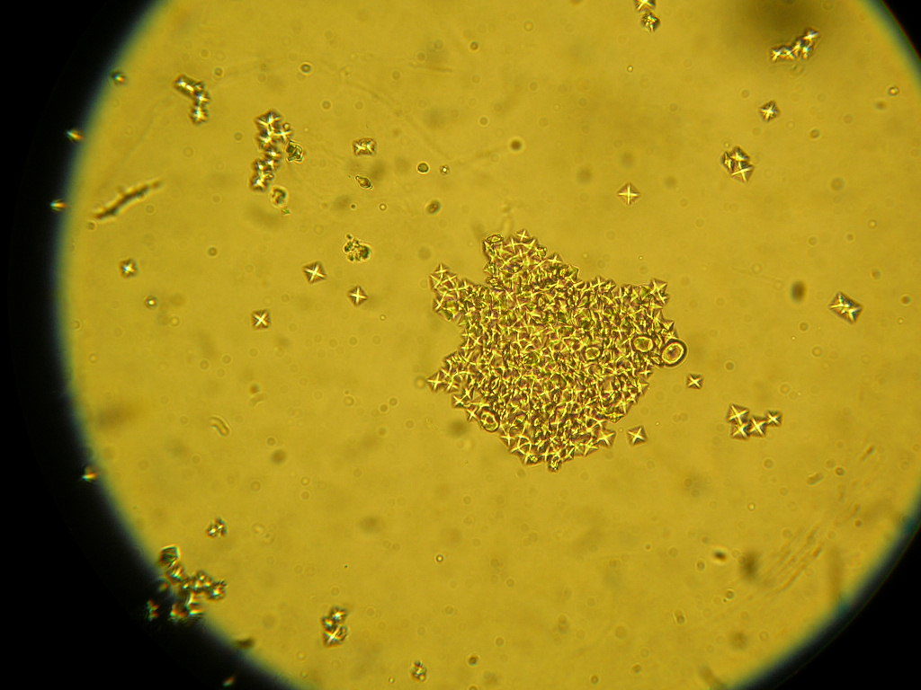 Ураты это. Оксалаты кальция под микроскопом. Микроскопия мочи Ураты оксалаты. Оксалаты в моче под микроскопом. Ураты в моче микроскопия.