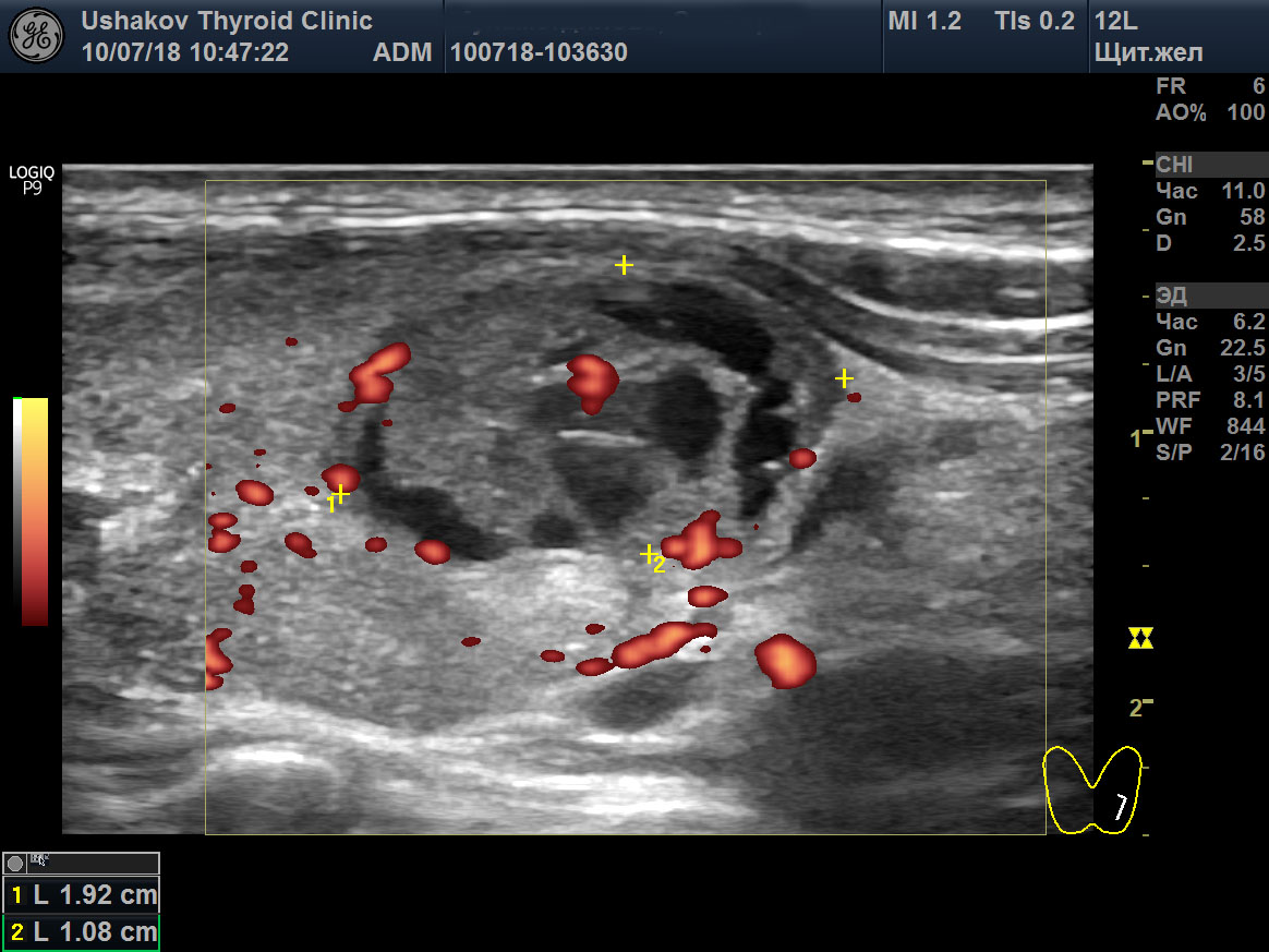 Узи щитовидной подготовка. Протокол УЗИ узел щитовидной железы. Протокол УЗИ щитовидной железы с допплерографией. Хорошее УЗИ щитовидной железы. Эластография щитовидной железы УЗИ протокол.