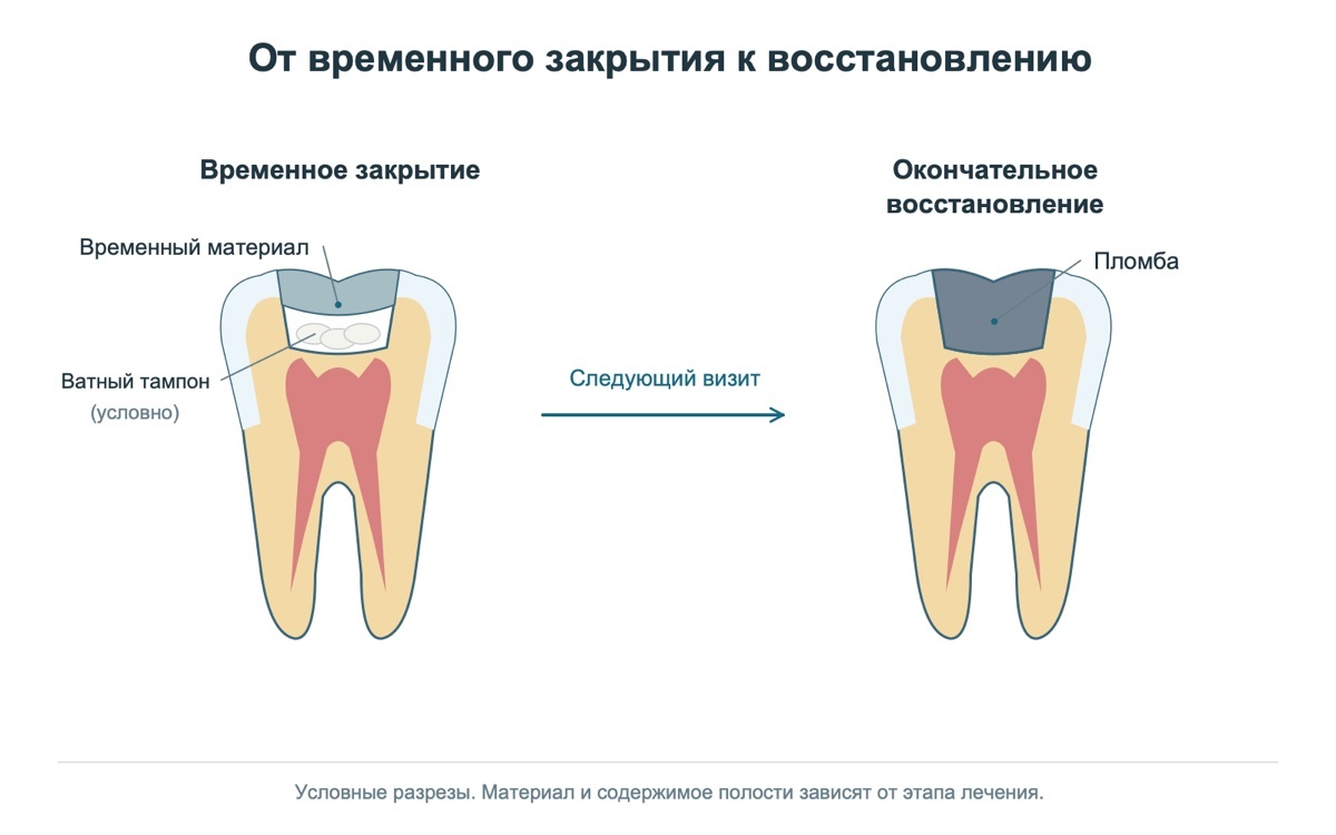 Временное закрытие зуба между этапами лечения