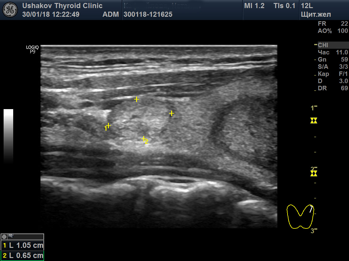 Узлы в щитовидной железе размеры норма