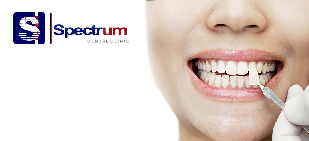 Реклама зубных имплантов. Поставить зубы чебоксары. Расценки зубных коронок. Акция на имплантацию зубов. Эстетические брекеты (керамические, сапфировые) (damon clear),.