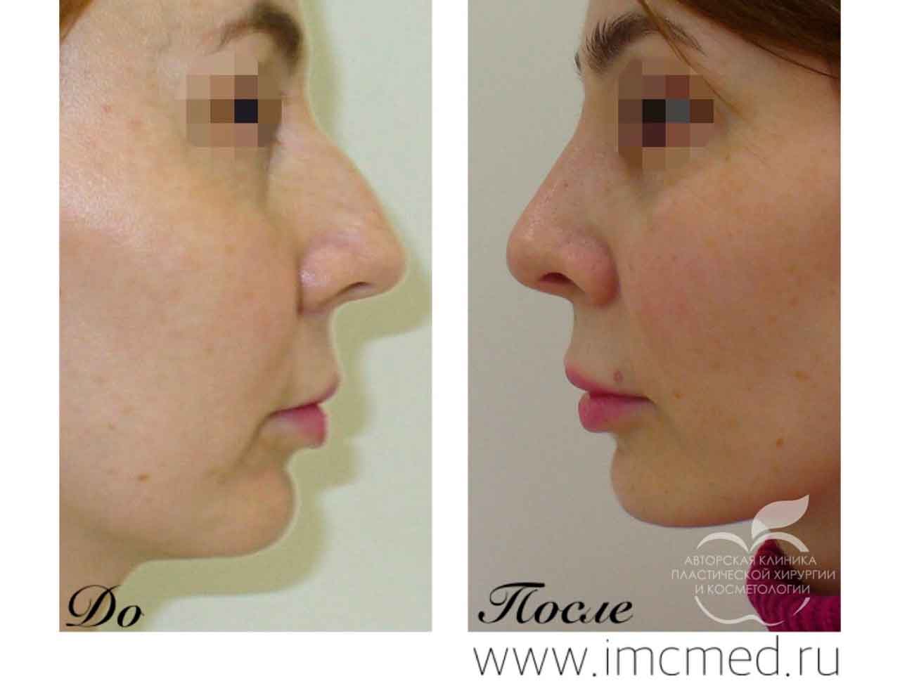 лина исбир ринопластика. ринопластика до и после. центр ринопластики. центр ринопластики. пластика кончика носа.